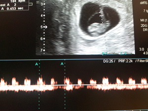 echographie datation