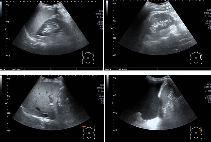 Echographie pelvienne