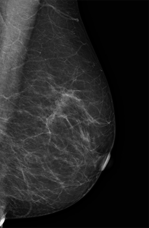 mammographie 2